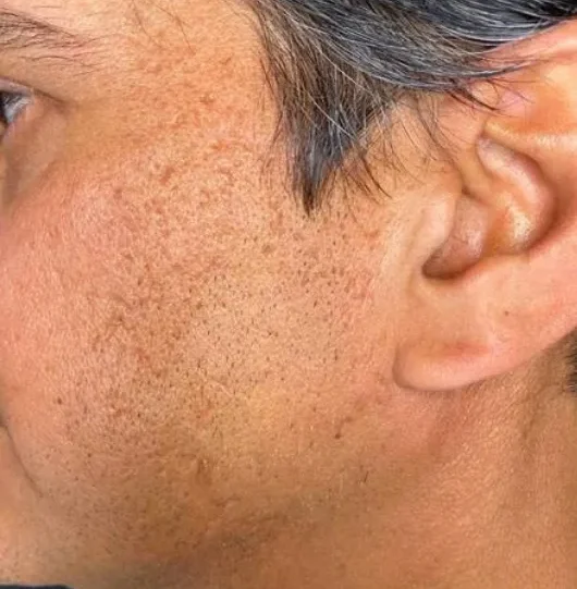 VirtueRFBAMaleFaceAcneScars1-6b21d35b-1920w