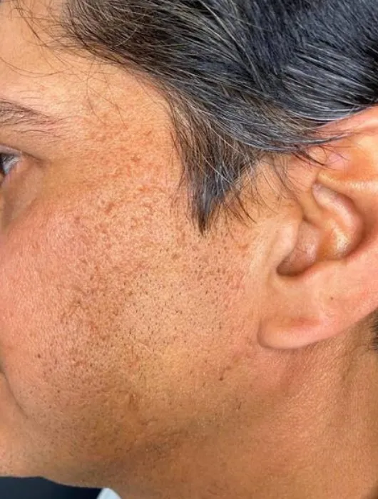 VirtueRFBAMaleFaceAcneScars1-6b21d35b-1920w